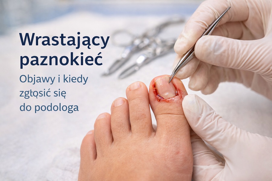 Wrastający paznokieć – kiedy domowe sposoby nie wystarczą?