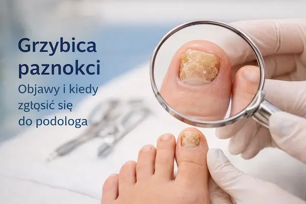 Grzybica paznokci – jak ją rozpoznać i skutecznie leczyć?