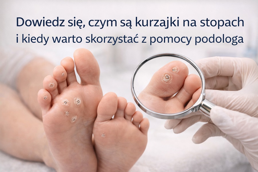 Kurzajki na stopach – co to jest i jak się ich pozbyć?