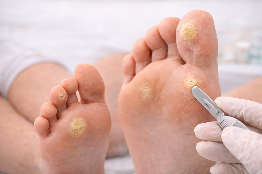 Modzele i odciski – jak je rozpoznać i kiedy są groźne?