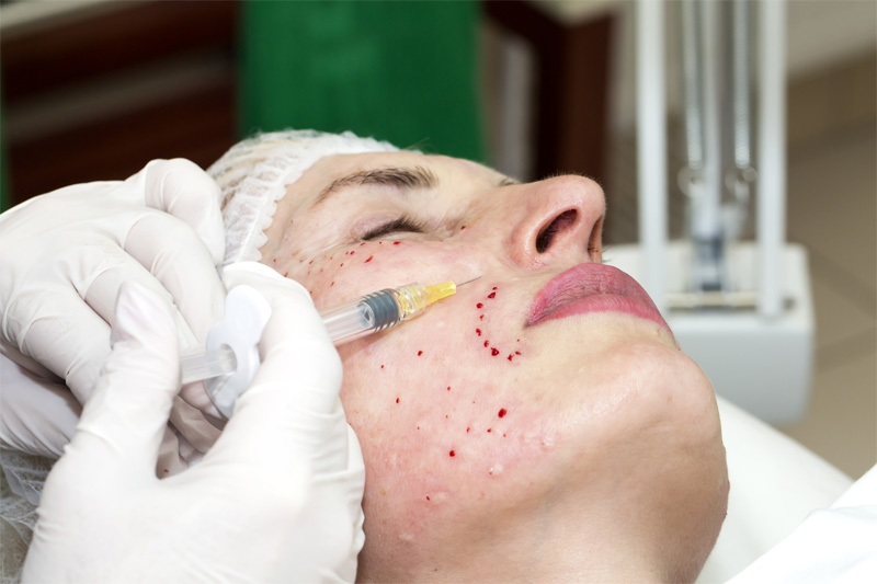 Mezoterapia porównanie