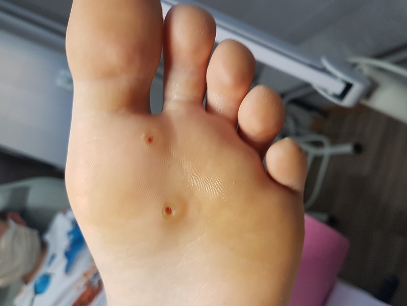 Zabiegi podologiczne - Klucz do Zdrowych i Pięknych Stóp