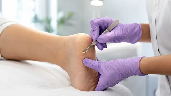 Poradnik podologiczny: Jak skutecznie wyleczyć pękające pięty? Pedicure krok po kroku