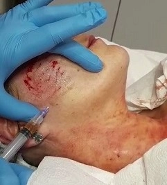 Wampirzy lifting (mezoterapia osoczem bogatopłytkowym) – naturalny sposób na odmłodzenie skóry