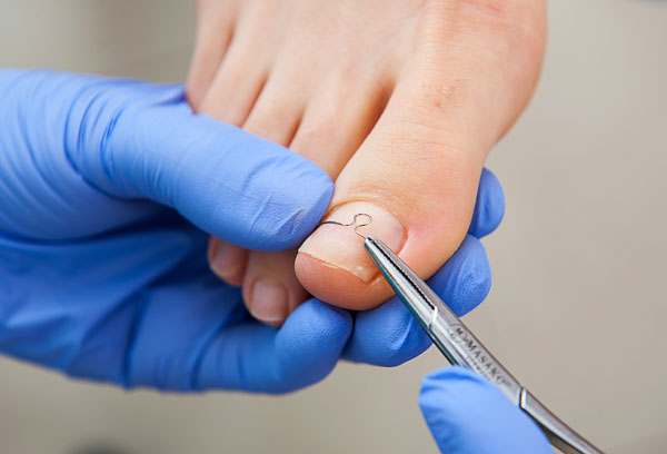 Wrastające paznokcie – przyczyny, leczenie i skuteczna profilaktyka | Centrum Kosmetyczne ELSA Rzeszów